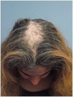 prp hair loss treatment before