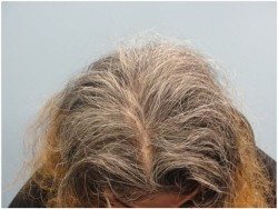 womens hair loss treatment philadelphia pa