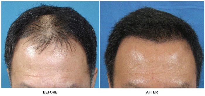 Before and After Hair Restoration