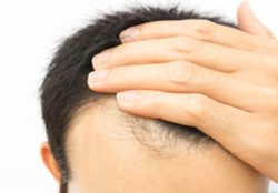 main with hair loss philadelphia pa hair loss treatment