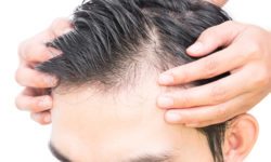 Hair Loss Philadelphia PA