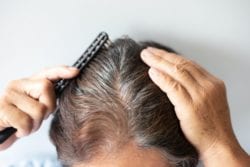 hair loss treatment in philadelphia, pennsylvania
