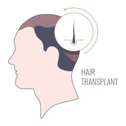 hair restoration treatment in philadelphia, pa